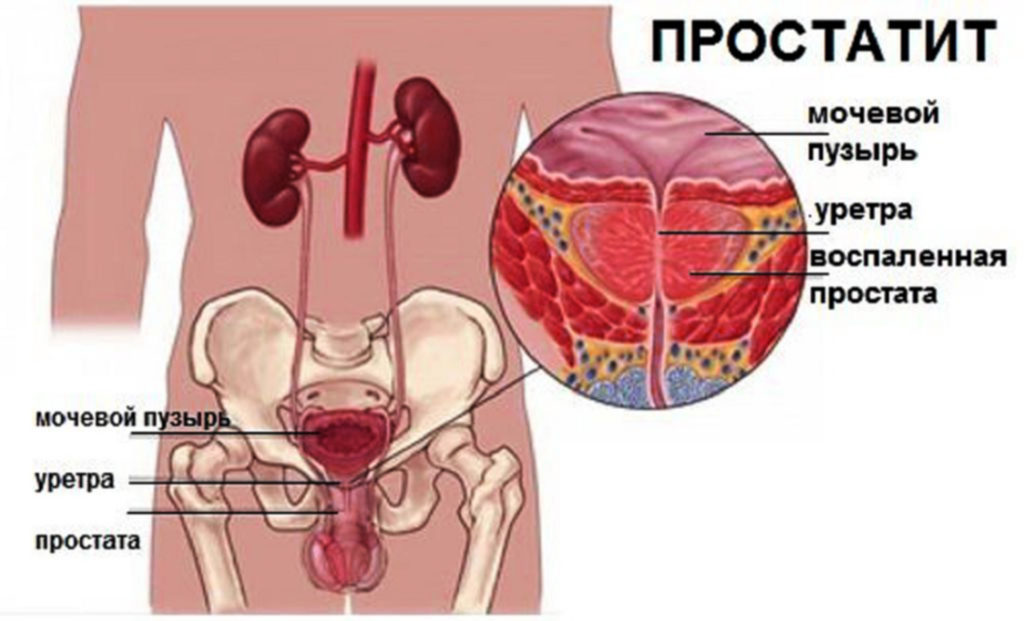 Простатит